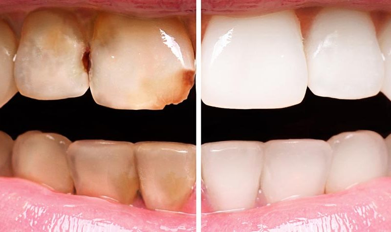 Before and after teeth whitening